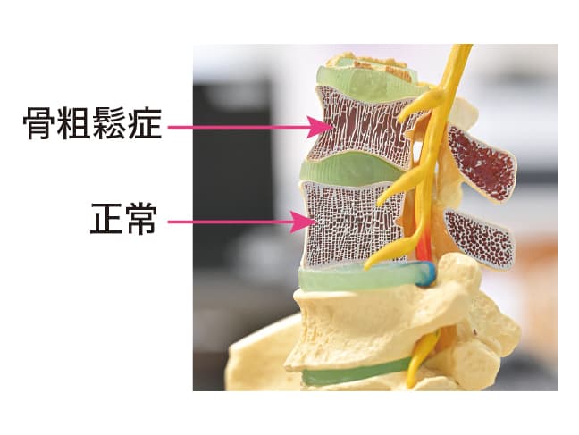 メディカル最前線vol.86 あなたの骨、元気ですか？ころぶ前に、折れる